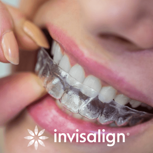 ALINHADORES INVISALIGN