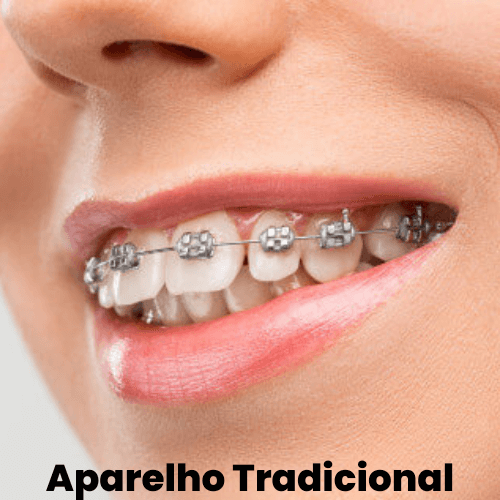APARELHO TRADICIONAL